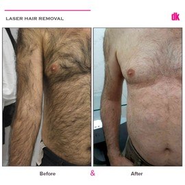 LASER HAIR REMOVAL - Male - Before and After
