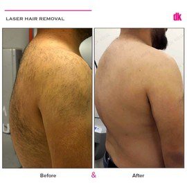 LASER HAIR REMOVAL - Male - Before and After