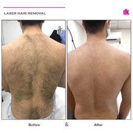 LASER HAIR REMOVAL - Male - Before and After
