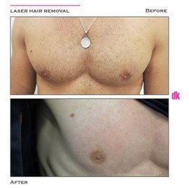 LASER HAIR REMOVAL - Male - Before and After