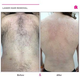 LASER HAIR REMOVAL - Male - Before and After