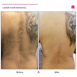 LASER HAIR REMOVAL - Male - Before and After
