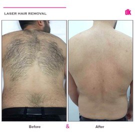 LASER HAIR REMOVAL - Male - Before and After