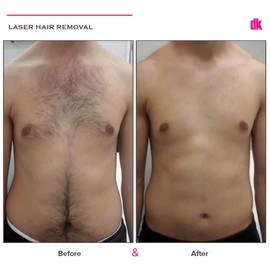 LASER HAIR REMOVAL - Male - Before and After
