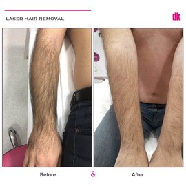 LASER HAIR REMOVAL - Male - Before and After