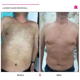 LASER HAIR REMOVAL - Male - Before and After
