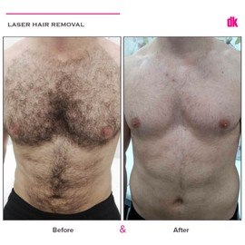LASER HAIR REMOVAL - Male - Before and After