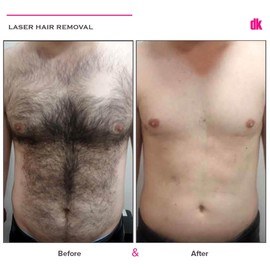 LASER HAIR REMOVAL - Male - Before and After