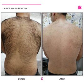 LASER HAIR REMOVAL - Male - Before and After