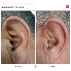 LASER HAIR REMOVAL - Male - Before and After