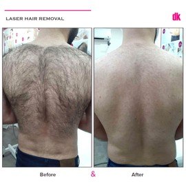 LASER HAIR REMOVAL - Male - Before and After