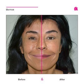 BOTOX - Crows Feet - Before and After