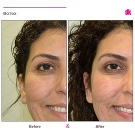 BOTOX - Crows Feet - Before and After