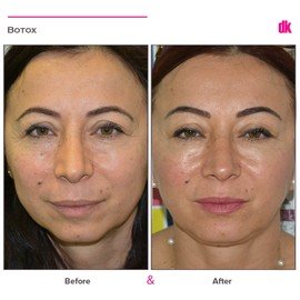 BOTOX - Crows Feet - Before and After