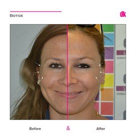 BOTOX - Crows Feet - Before and After