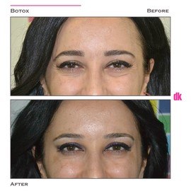 BOTOX - Crows Feet - Before and After