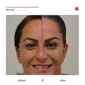 BOTOX - Crows Feet - Before and After