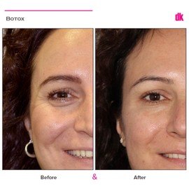 BOTOX - Crows Feet - Before and After