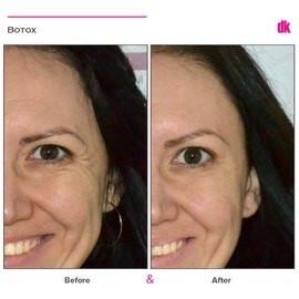 BOTOX - Crows Feet - Before and After