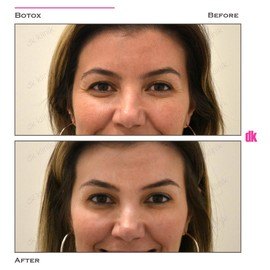 BOTOX - Crows Feet - Before and After