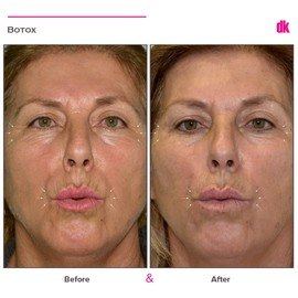 BOTOX - Crows Feet - Before and After