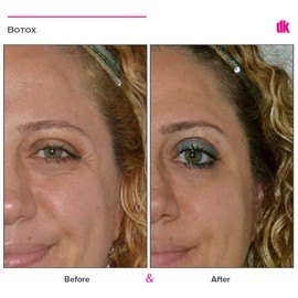 BOTOX - Crows Feet - Before and After