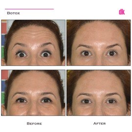 BOTOX - Crows Feet - Before and After