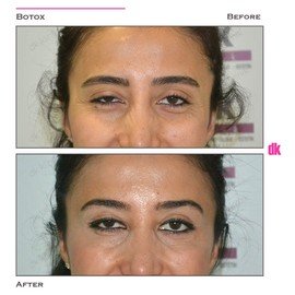 BOTOX - Crows Feet - Before and After