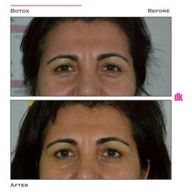 BOTOX - Crows Feet - Before and After