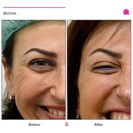BOTOX - Crows Feet - Before and After