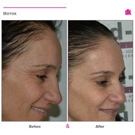 BOTOX - Crows Feet - Before and After
