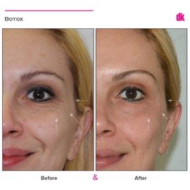 BOTOX - Crows Feet - Before and After