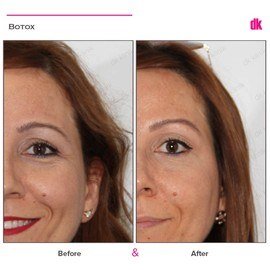 BOTOX - Crows Feet - Before and After