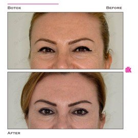 BOTOX - Crows Feet - Before and After
