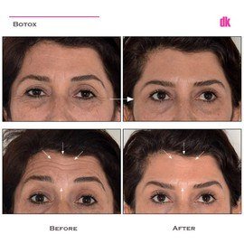 BOTOX - Crows Feet - Before and After