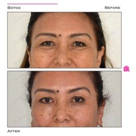 BOTOX - Crows Feet - Before and After