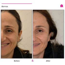 BOTOX - Crows Feet - Before and After