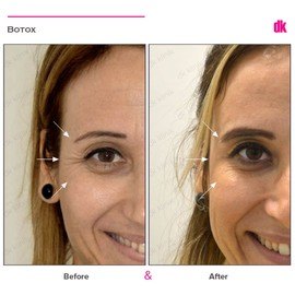 BOTOX - Crows Feet - Before and After