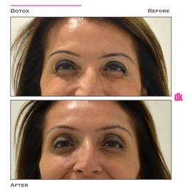 BOTOX - Crows Feet - Before and After