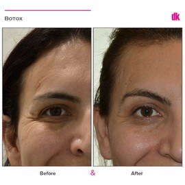 BOTOX - Crows Feet - Before and After
