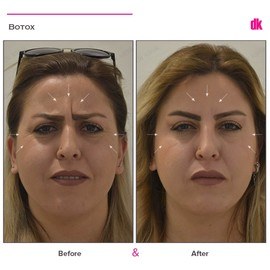 BOTOX - Crows Feet - Before and After