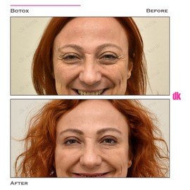 BOTOX - Crows Feet - Before and After