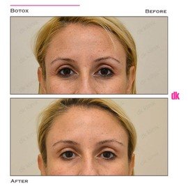 BOTOX - Crows Feet - Before and After
