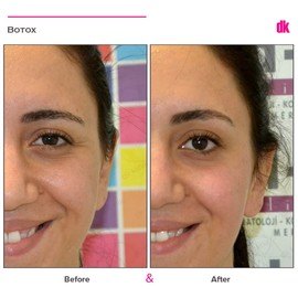 BOTOX - Crows Feet - Before and After