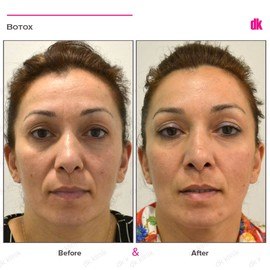 BOTOX - Crows Feet - Before and After