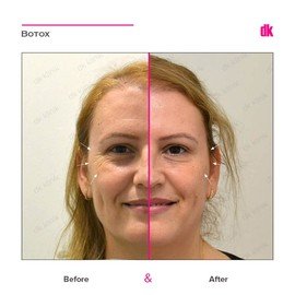 BOTOX - Crows Feet - Before and After