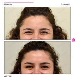 BOTOX - Crows Feet - Before and After