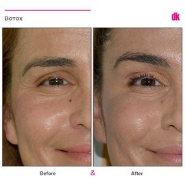 BOTOX - Crows Feet - Before and After