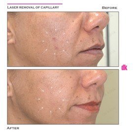 LASER TREATMENT OF CAPILLARY - Before and After