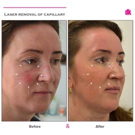 LASER TREATMENT OF CAPILLARY - Before and After